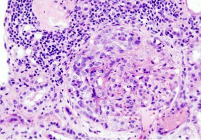 Уремия под микроскопом