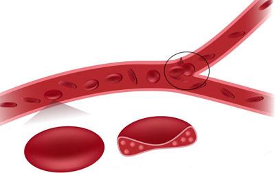 Закупорка сосуда