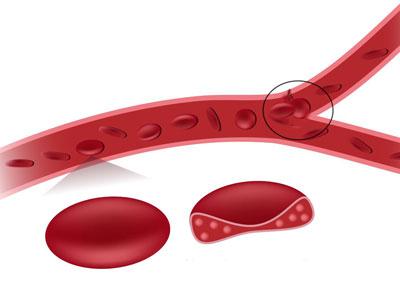 Закупорка брыжечной артерии