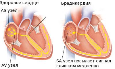 Проявление брадикардии