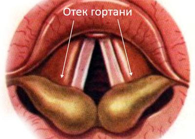 Отек гортани