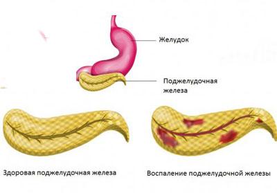 Проявление панкреатита
