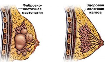 Проявление мастопатии