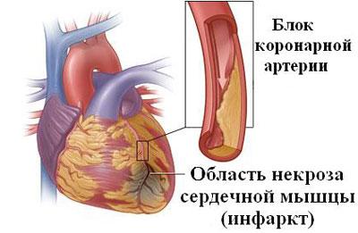 Инфаркт миокарда