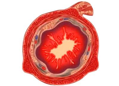 Кишечник при болезни Уиппла