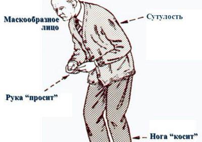 Болезнь паркинсона