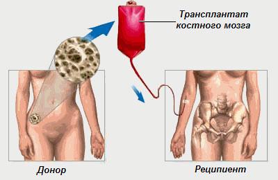 Пересадка костного мозга