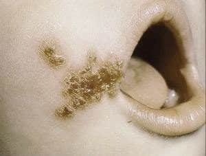 Impetigo2-300x227.jpg
