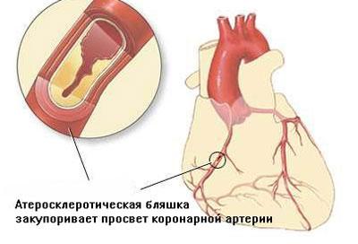 Ишемическая болезнь сердца