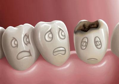 Зуб с кариесом