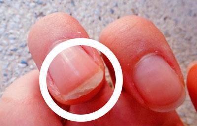 Слоятся ногти