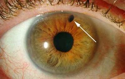 Проявление глаукомы