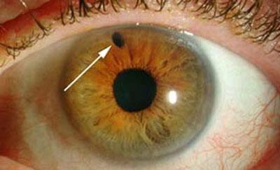 Глаукома у человека