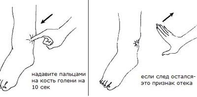 Признак отечности