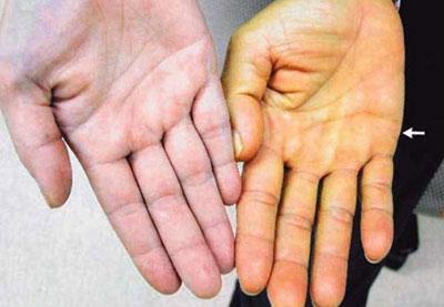 Пожелтевшая кожа руки