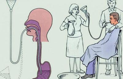 Промывание желудка