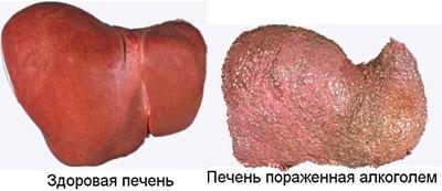 Печень при алкоголизме