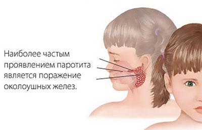 Паротит у ребенка