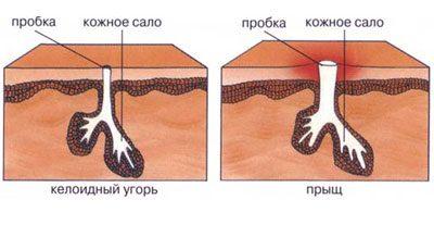 Возникновение сыпи