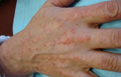 Лекарственная аллергия