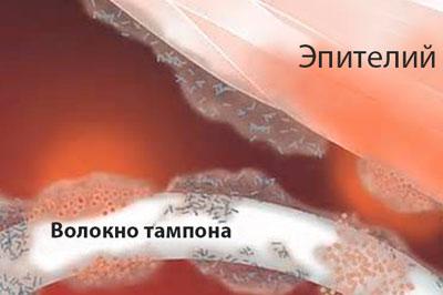 Токсический шок со стафилококковым типом