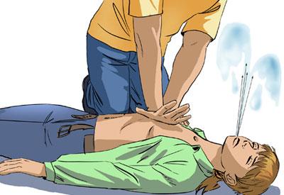 Непрямой массаж сердца