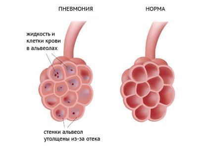 Легкие при пневмонии