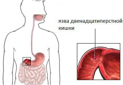 Язва двенадцатиперстной кишки