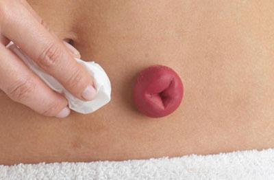 Выведение илеостомы