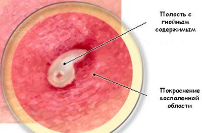 Абсцесс на коже