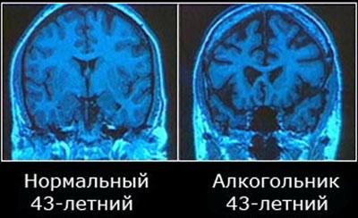 Головной мозг алкоголика