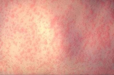 Сыпь при аллергии