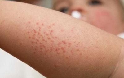 Сыпь у ребенка