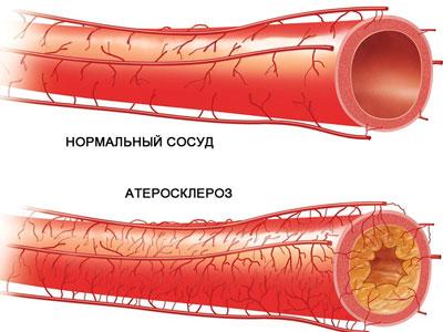 Атеросклероз сосудов
