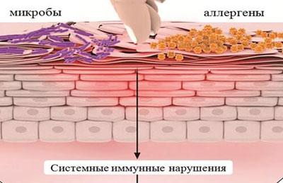 Атопический дерматит