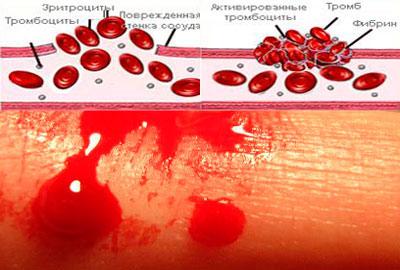 Плохая свертываемость крови