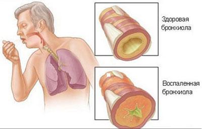 Проявление бронхита