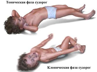 Судороги у ребенка