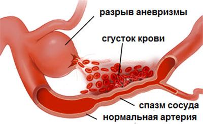 Спазм сосудов
