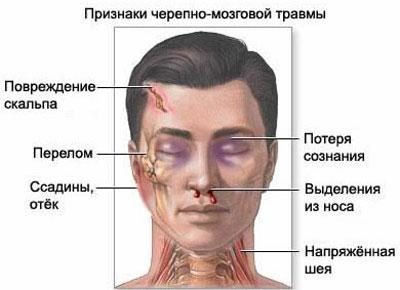 Признаки черепно мозговой травмы
