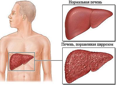 Цирроз печени