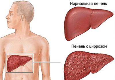 Цирроз печени