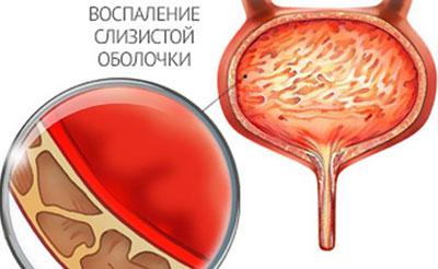Признак цистита