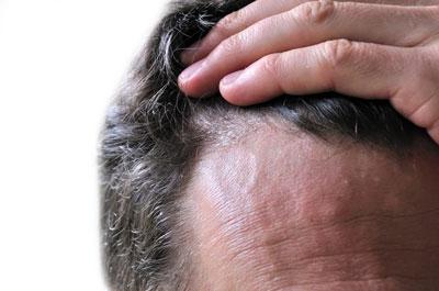 Экзема кожи головы