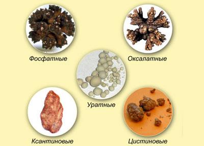 Виды камней в почках