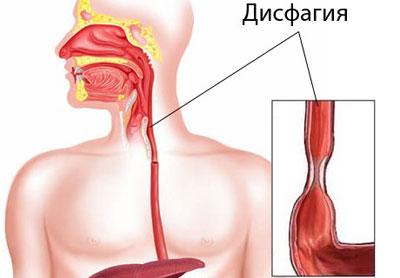 Проявление дисфагии