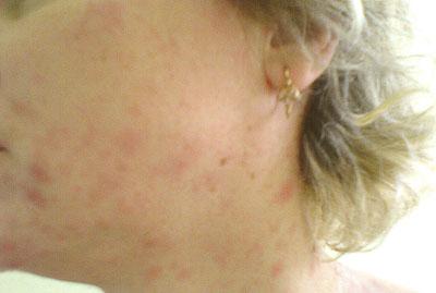 Сыпь при эритеме