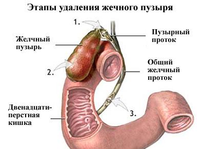 Удаление желчного пузыря
