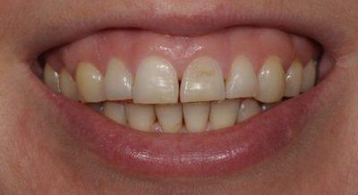 Зубная эмаль