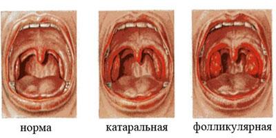 Виды ангины